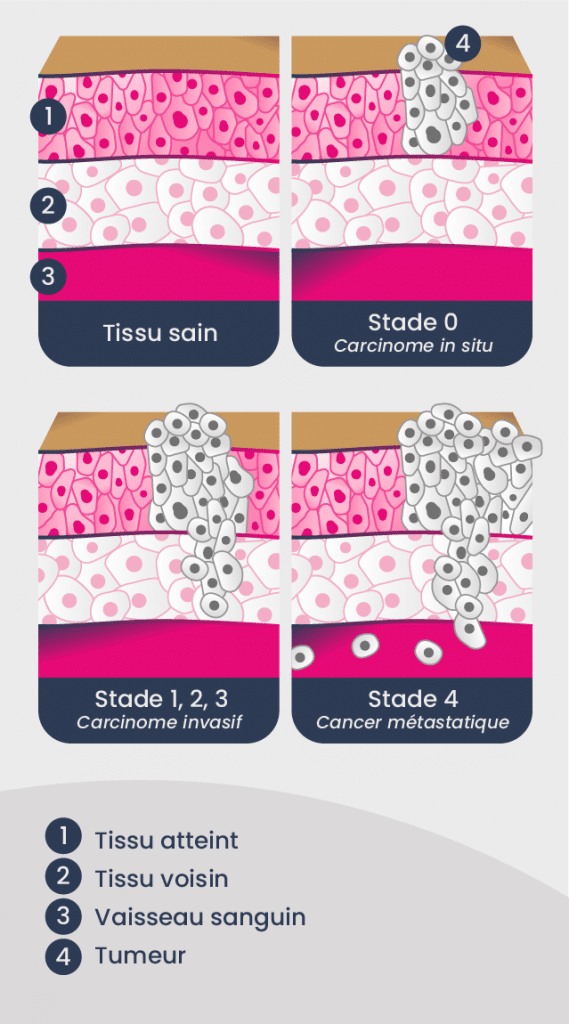 Types de cancers du sein