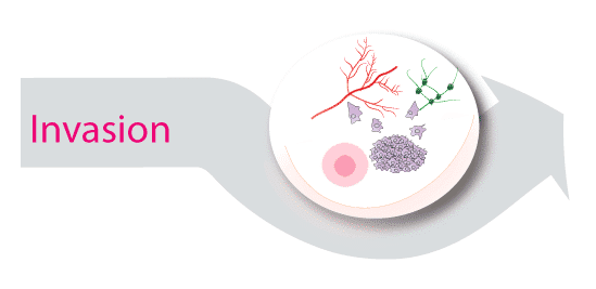 Le cancer du sein métastatique démystifié