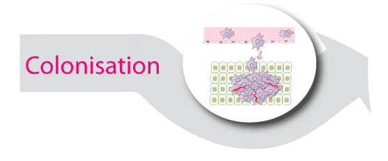 Le cancer du sein métastatique démystifié